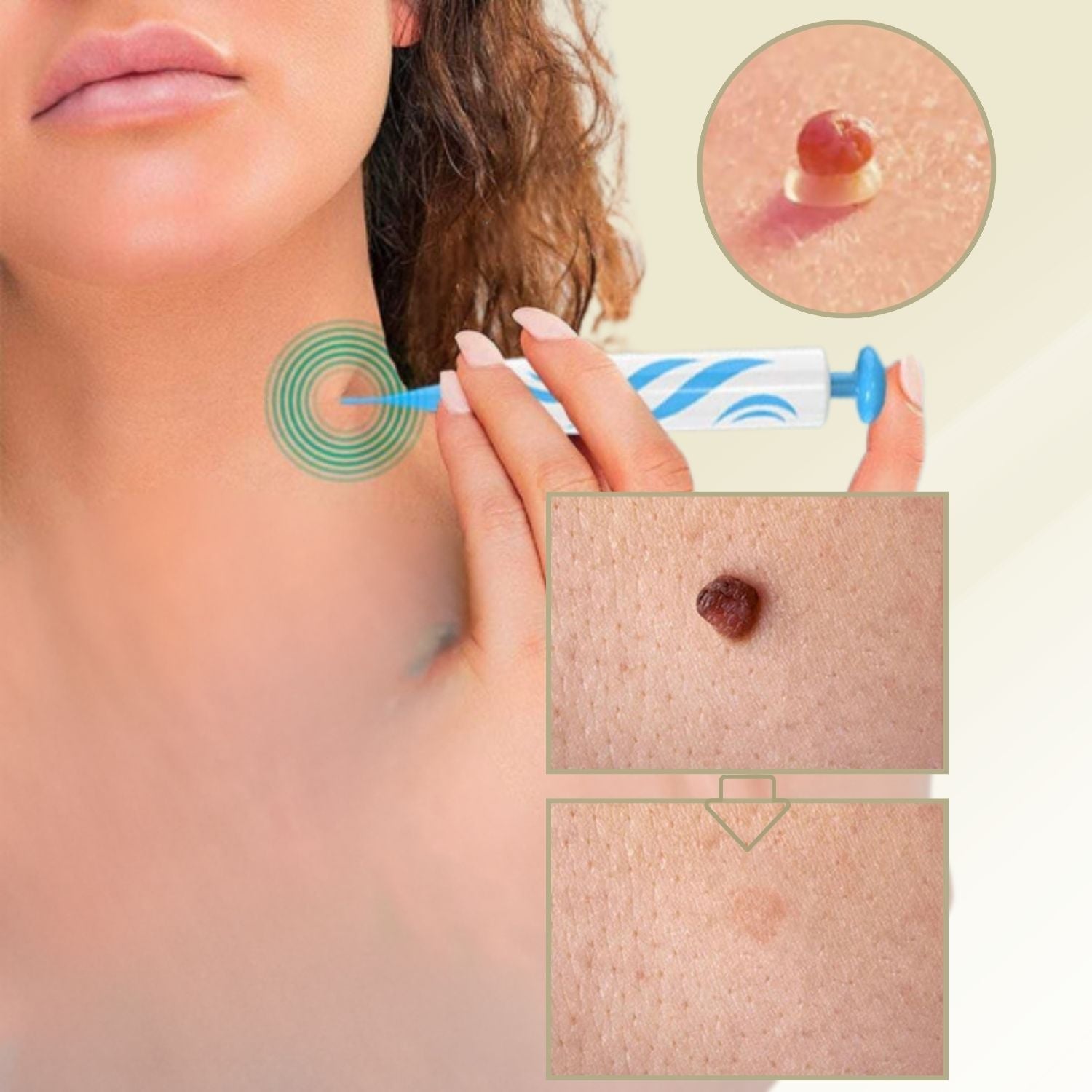 Pain-Free Wart & Mole Remover for Home Use | No Surgery Needed