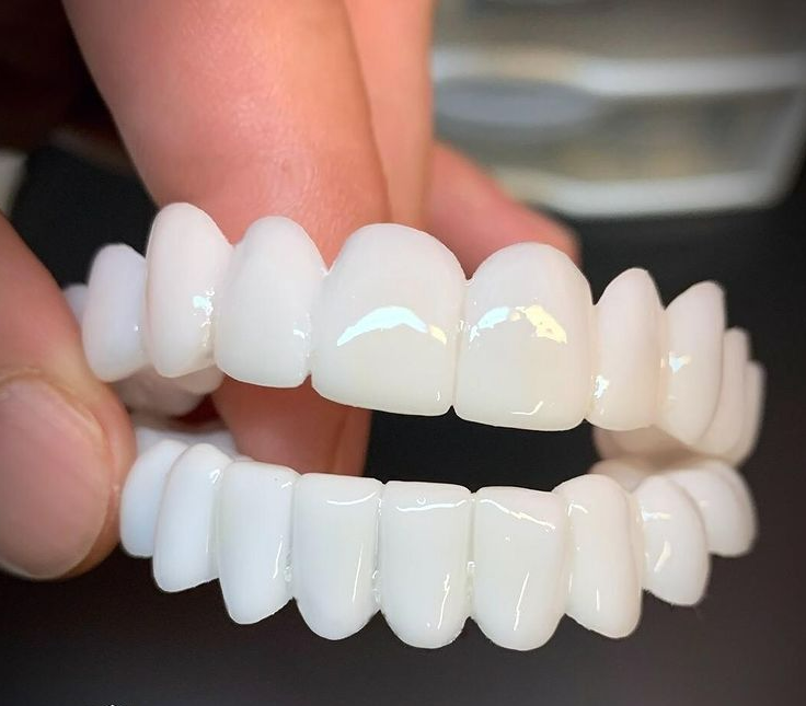 Dental Veneers for a Natural Fit and Comfortable Smile
