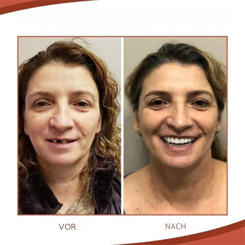 Biocompatible Prosthesis Kit for Comfortable Fit and Authentic Smile