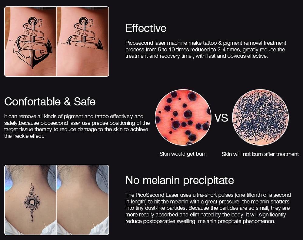 Instant Laser Device for Dark Spot & Tattoo Removal
