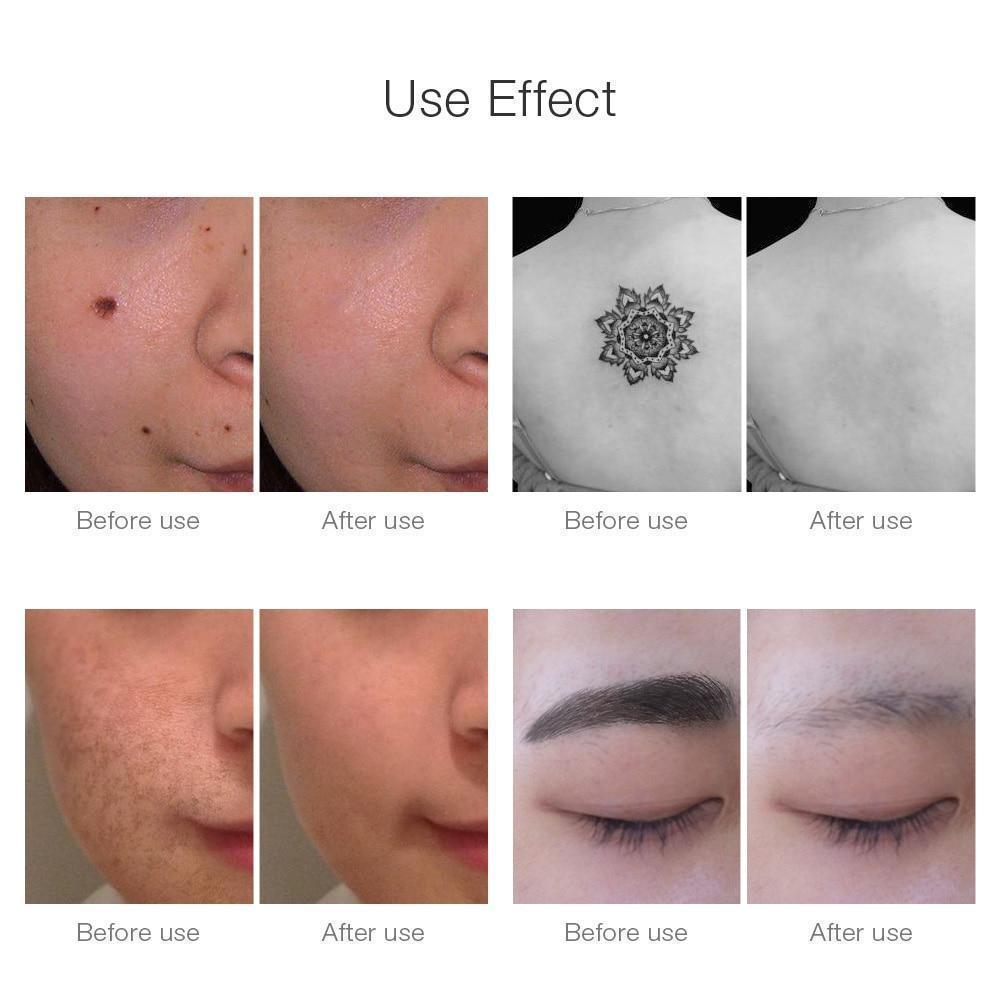 Instant Laser Device for Dark Spot & Tattoo Removal